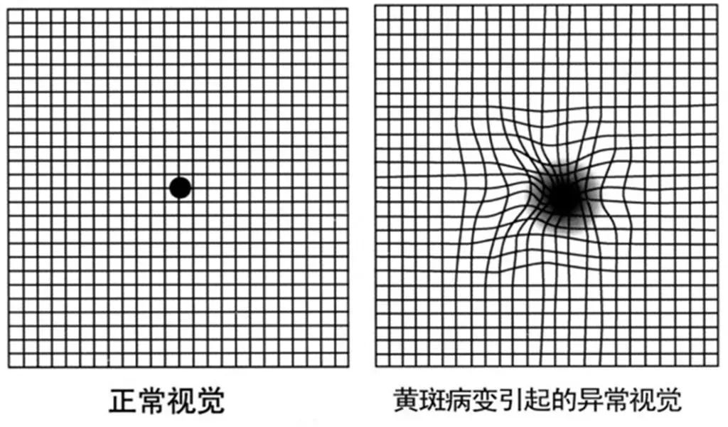 看东西发生扭曲，是什么眼病？